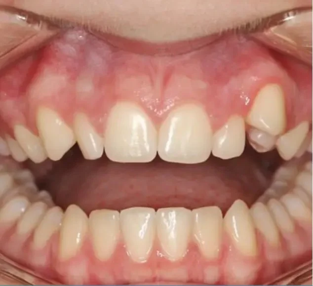 Before — crowded teeth correction with Invisalign at Paulus Dental