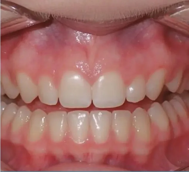 After — straight aligned smile with Invisalign at Paulus Dental