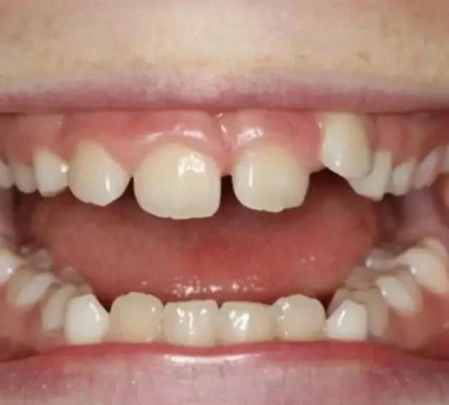 Before — gap closure with Invisalign at Paulus Dental