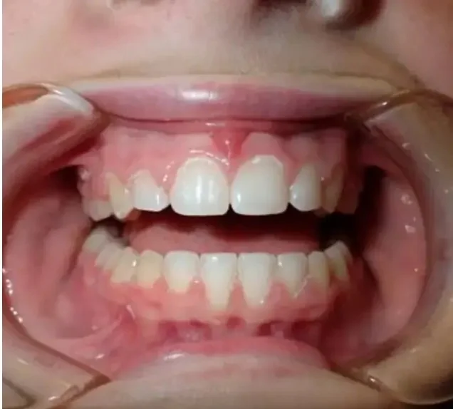 After — gap closed beautifully aligned smile