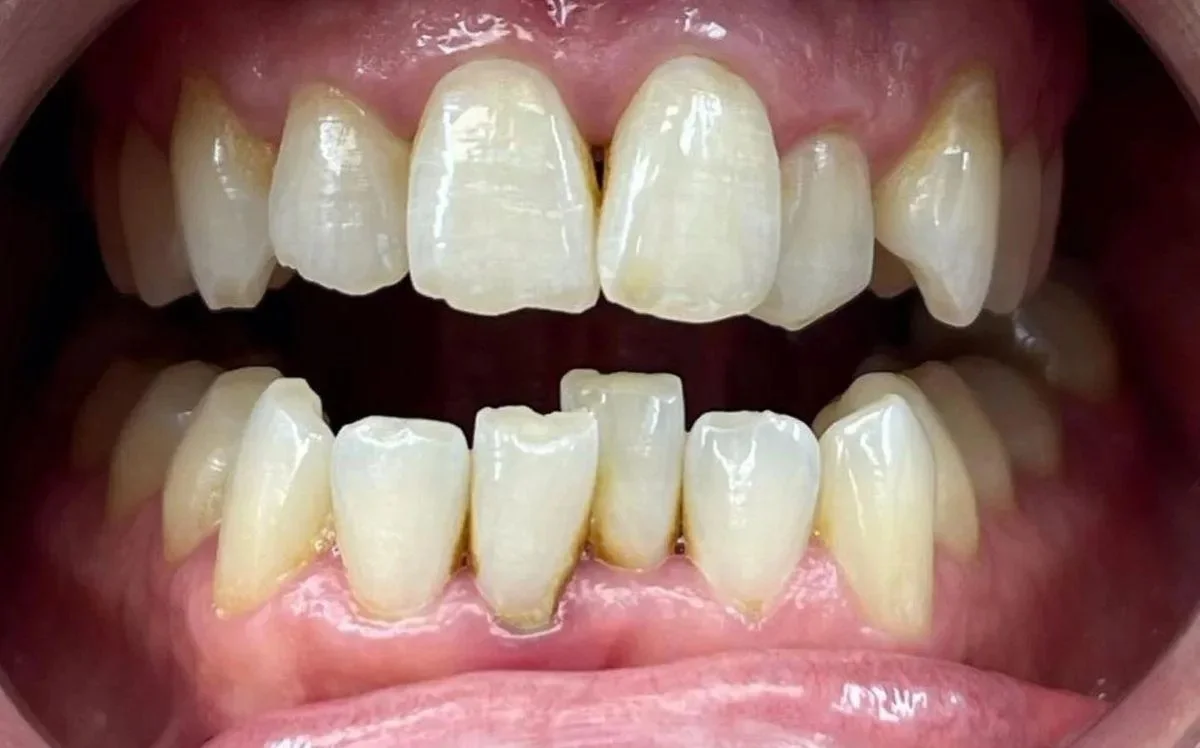 Before — bite correction with Invisalign at Paulus Dental
