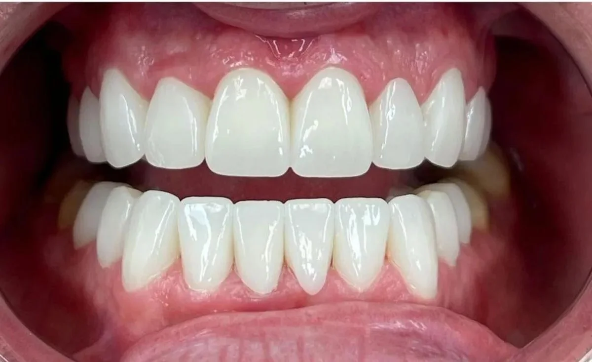 After — complete smile makeover with Invisalign at Paulus Dental